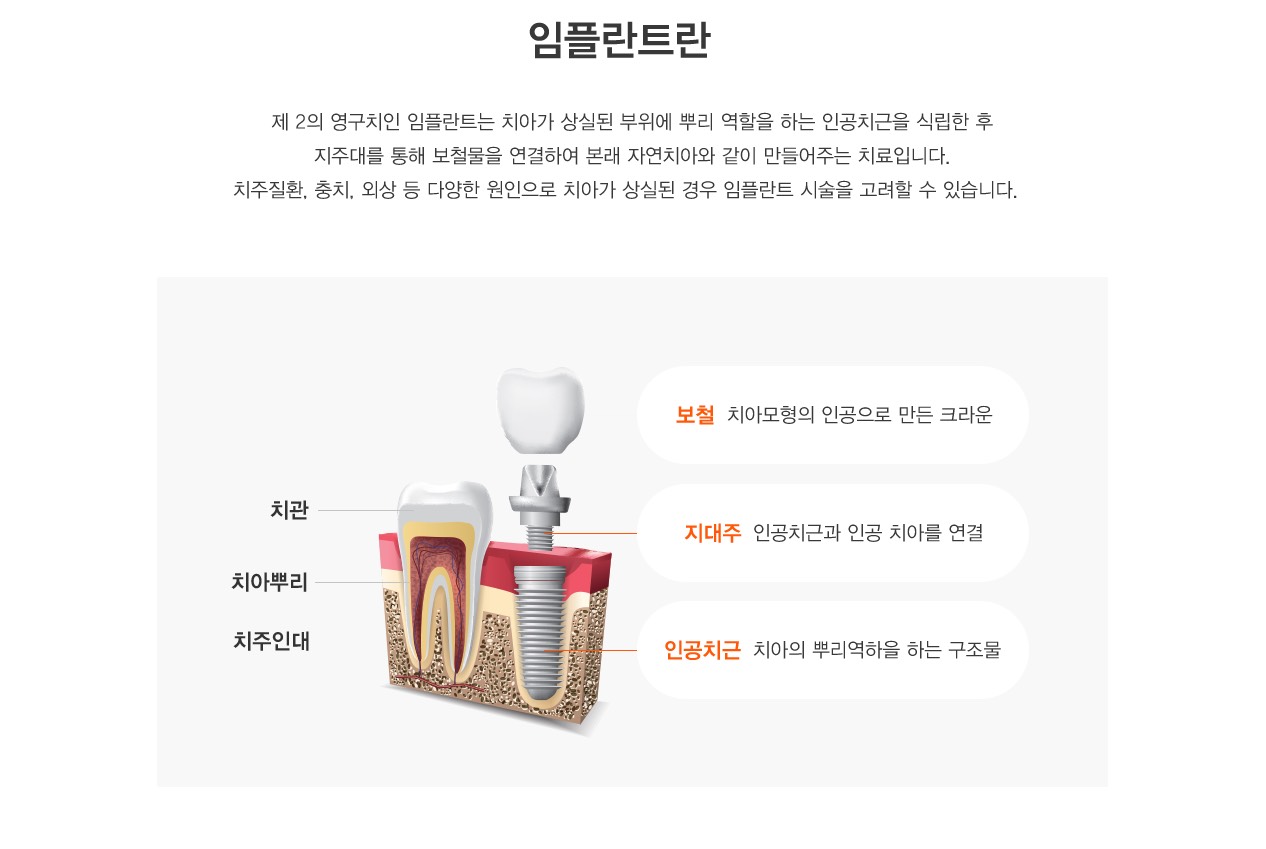 임플란트란? 제 2의 영구치인 임플란트는 치아가 상실된 부위에 뿌리 역할을 하는 인공치근을 식립한 후
                    지주대를 통해 보철물을 연결하여 본래 자연치아와 같이 만들어주는 치료입니다.
                    치주질환, 충치, 외상 등 다양한 원인으로 치아가 상실된 경우 임플란트 시술을 고려할 수 있습니다.