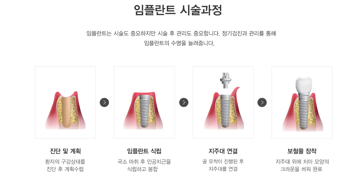 임플란트 시술과정 임플란트는 시술도 중요하지만 시술 후 관리도 중요합니다. 정기검진과 관리를 통해
                  임플란트의 수명을 늘려줍니다.  
